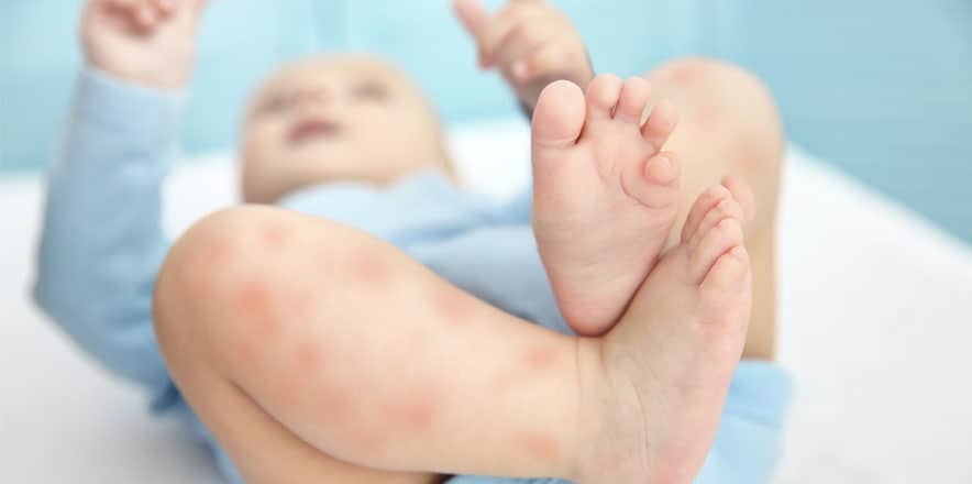 eczema treatment los angeles