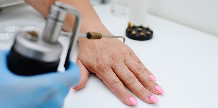warts vs corns los angeles dermatologist