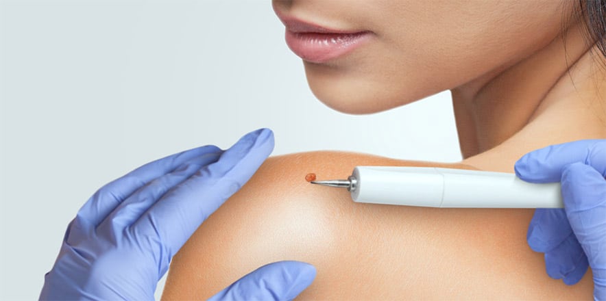 la dermatologist for mole removal