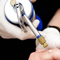 Cryotherapy wart removal