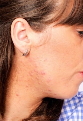 acne treatment