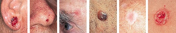 basal cell carcinoma info