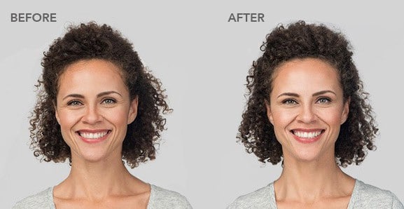 botox before after pictures 1