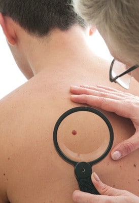 dermatologist mole removal