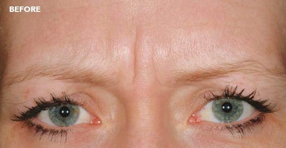 dysport before results 2