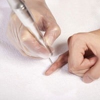 laser wart removal beverly hills