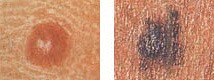 round mole next to asymmetrical unshapely darker mole, possibly indicative of melanoma