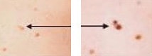 melanoma evolving