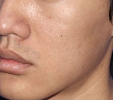 microneedling after acne pic 2