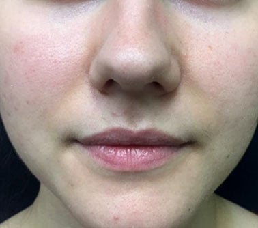 microneedling after acne pic