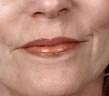 microneedling anti aging after pic