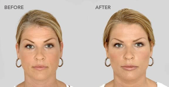 restylane before after pictures 1