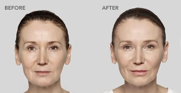 restylane before after pictures 2