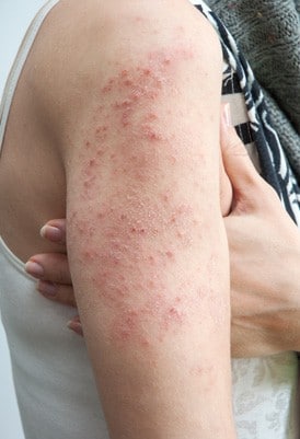 skin rash treatment 2