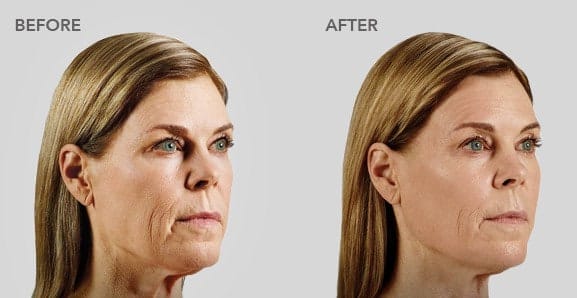 voluma before after pictures 1