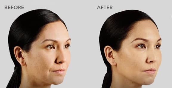 voluma before after pictures 2b