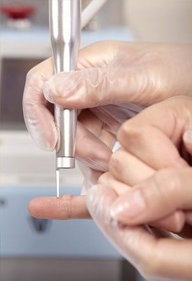 dermatologist treating and removing a wart on a finger