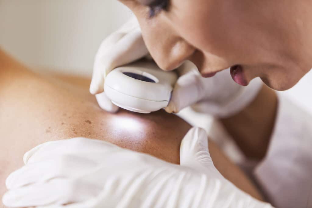 Skin Cancer Risks After Age 65