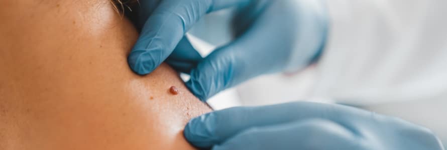 hands in blue gloves touching skin near mole on patient