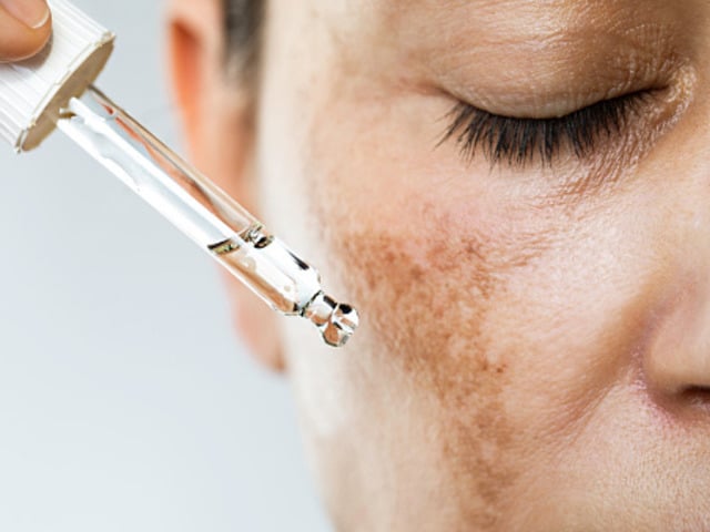 www.toplosangelesdermatologist.com sun spot treatment (1)