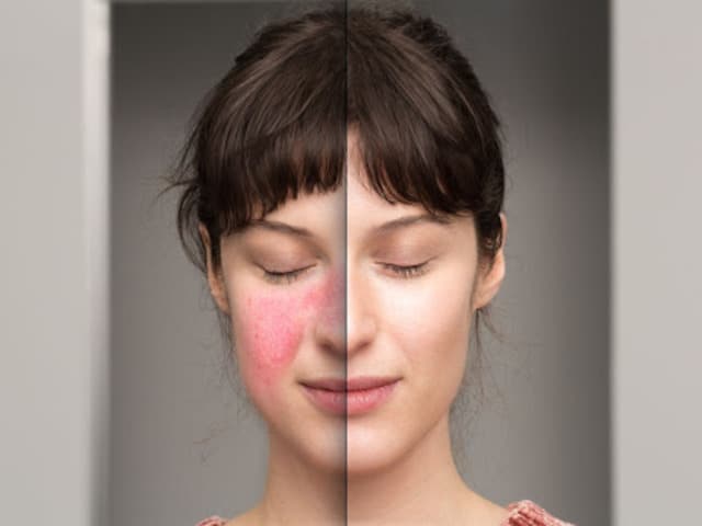 Rosacea