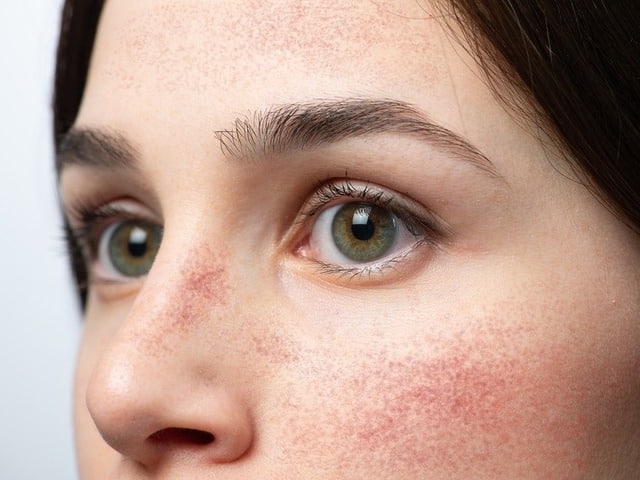 winter rosacea