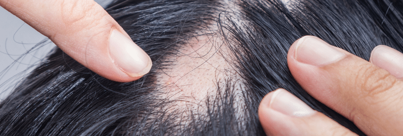 Reversing Alopecia Areata Hair Loss