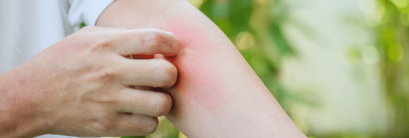 Spring Allergies in Los Angeles, CA