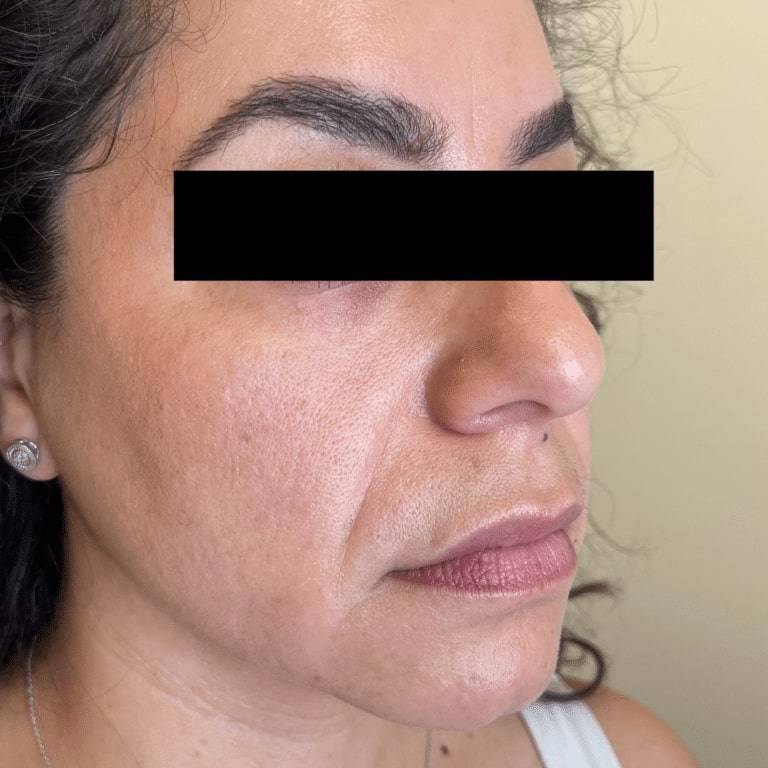 Before Image: Facial Filler and Botox - right-front-oblique