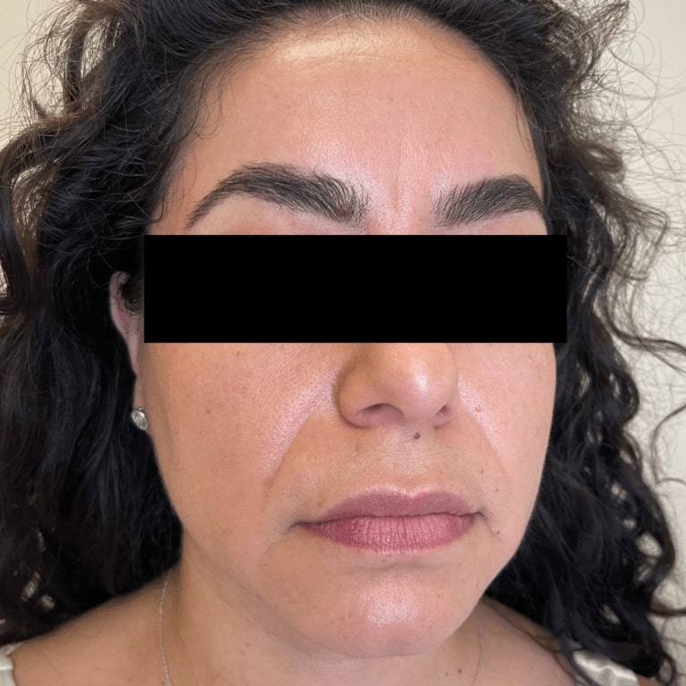 Before Image: Facial Filler and Botox - front