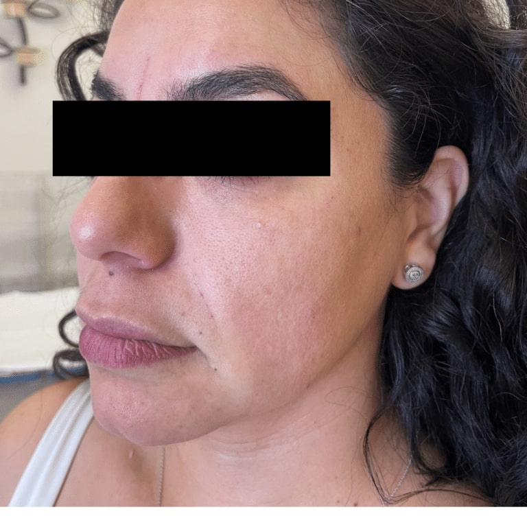 After Image: Facial Filler and Botox - left-front-oblique