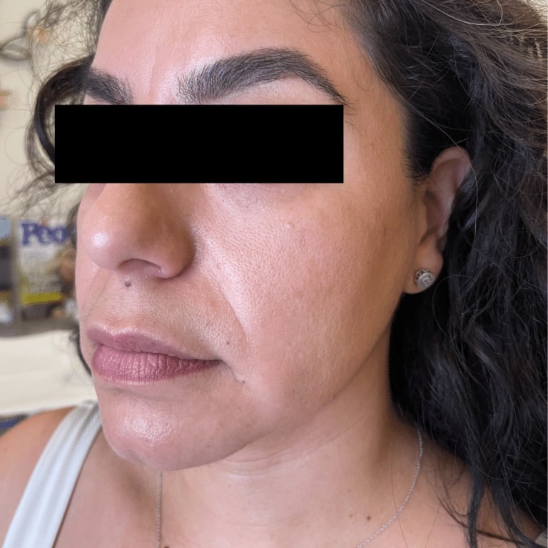 Before Image: Facial Filler and Botox - left-front-oblique