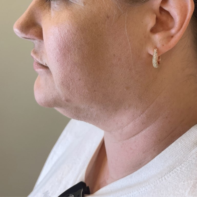 Before Image: Lip Filler - left-side