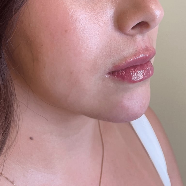 After Image: Lip Filler - right-front-oblique