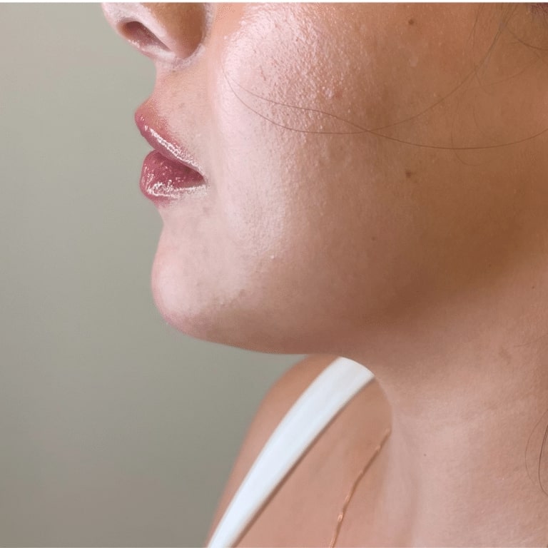 After Image: Lip Filler -