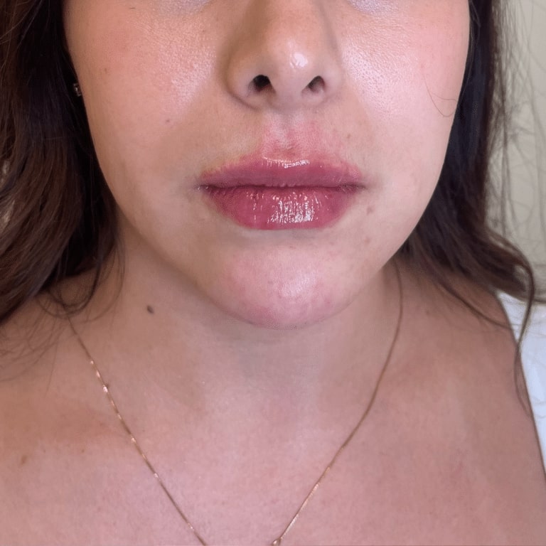 After Image: Lip Filler - front