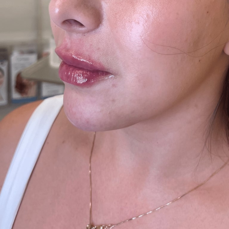 Before Image: Lip Filler - left-front-oblique