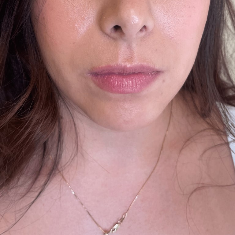 Before Image: Lip Filler - front