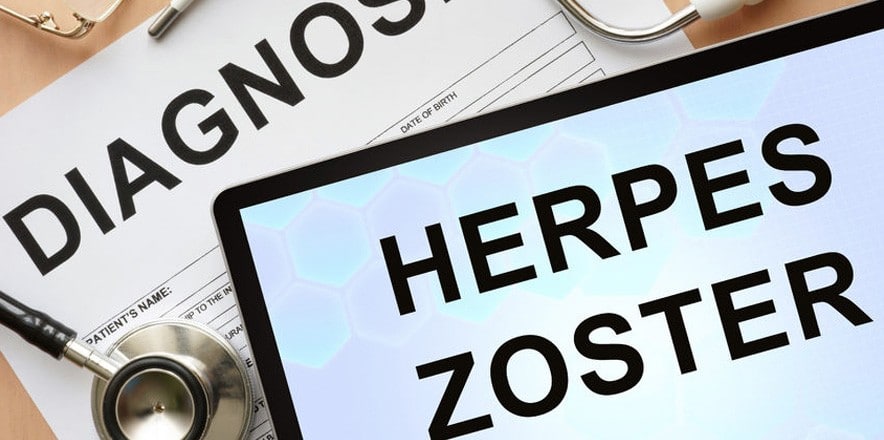 treatment herpes zoster