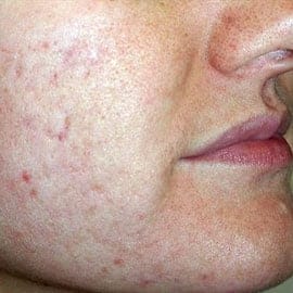 affirm treatment acne scars after