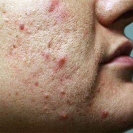 affirm treatment acne scars