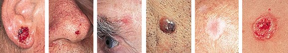 basal cell carcinoma info