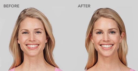 botox before after pictures 2
