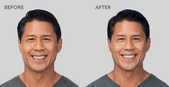 botox before after pictures 3