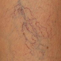 close up image of spider veins