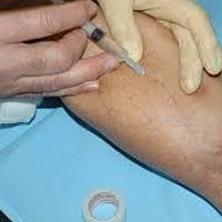 sclerotherapy treatment being done on legs