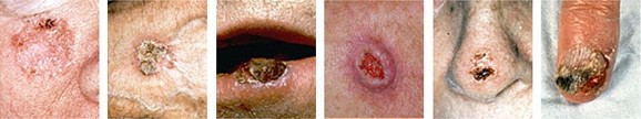 squamous cell carcinoma treatment