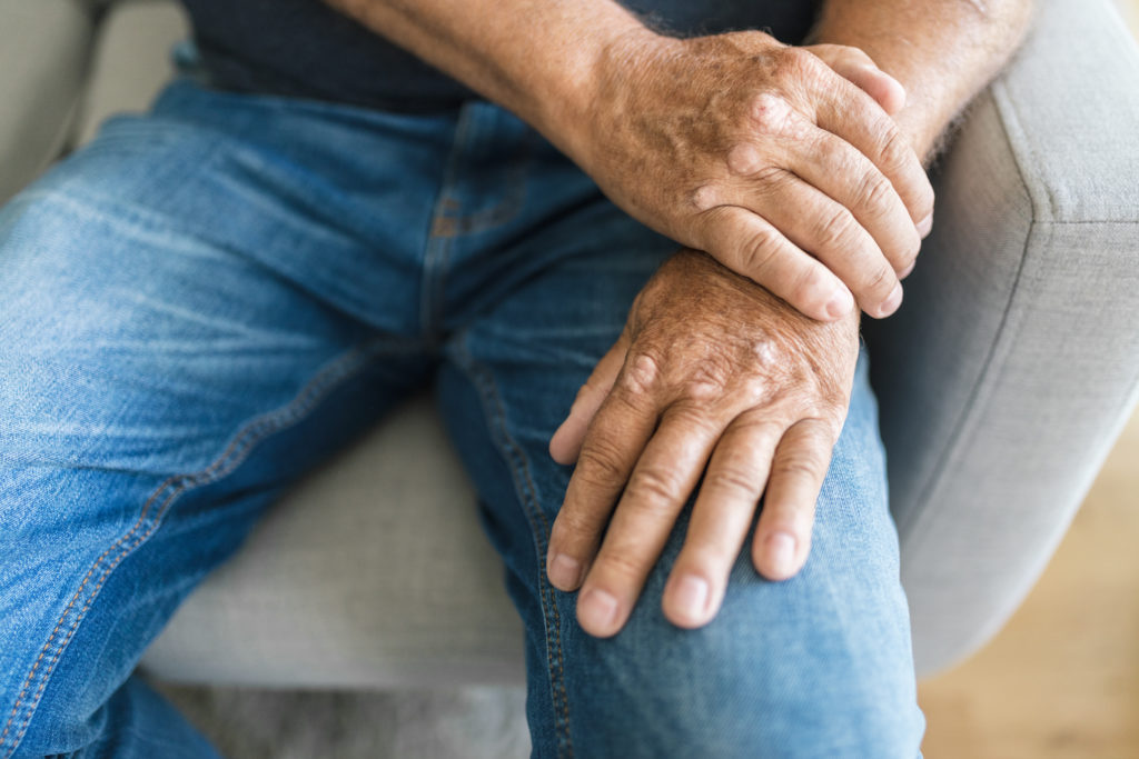 elderly man suffering from psoriasis on hands 2022 06 02 10 08 56 utc