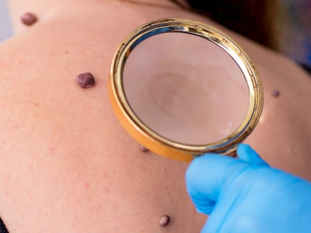 Dermatologist examining moles of patient with magnifying glass