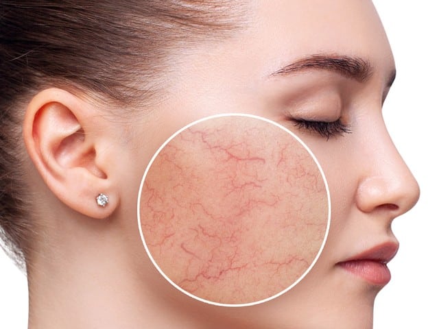Zoom circle of woman with couperose on face skin.